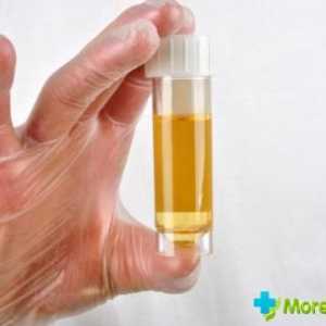 Uzroci bijeli urin u muškaraca i žena