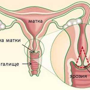 Uzrok vrata maternice endocervicosis i tretmani