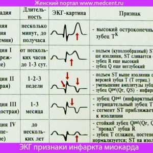 EKG znakova infarkta miokarda. Slike i objašnjenja