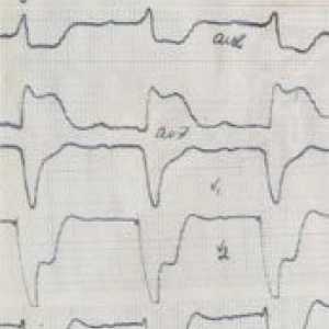 EKG znakovi akutnog infarkta miokarda. Slike i objašnjenja