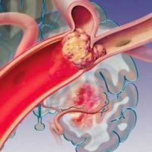 Vaskularne embolije, arterijske: vrste, simptoma, liječenje, prevencija