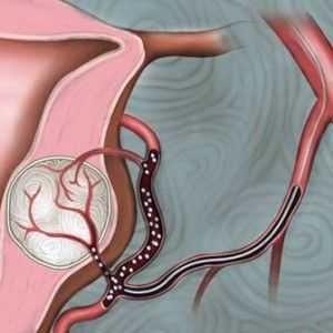 Embolizacija od miom maternice arterija: dokazi, postupak, rezultati