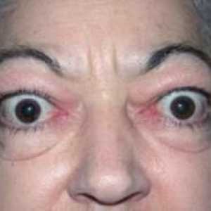 Endokrini oftalmopatija: njeno liječenje, dijagnoza i obrasci