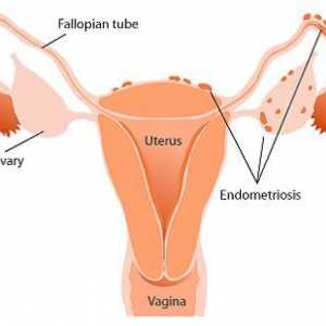 Simptomi endometrioza maternice i liječenje