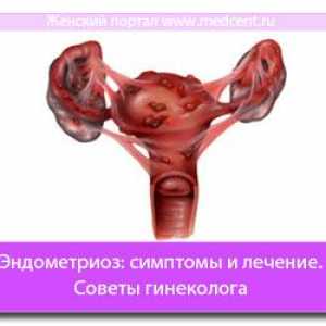 Endometrioza: Simptomi i liječenje. Savjet ginekolog
