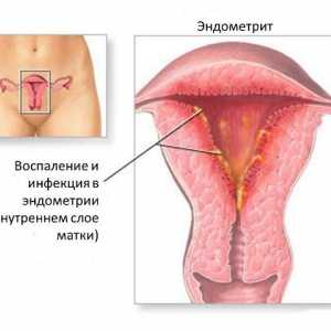 Endometrioza i endometrioze - u skladu s imenom, ali različitih dijagnoza