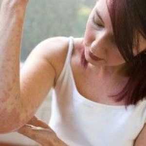 Erythrasma liječenje i simptomi