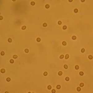 Crvene krvne stanice u urinu