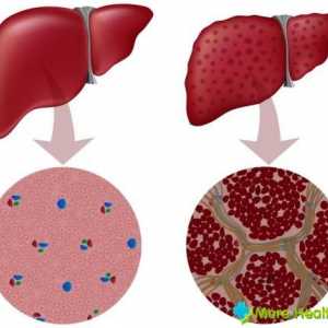 Kako liječiti jetrene ciroze narodnih lijekova? Simptomi i dijeta