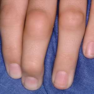 Kako liječiti otečene zglobove prstiju