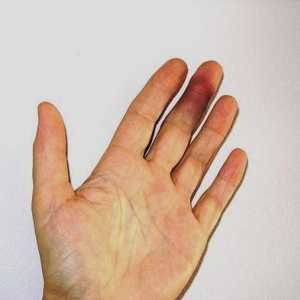 Kako mogu ukloniti brzo i efikasno oteklina s prstima