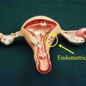 Kako prepoznati endometriozu i maternice ga izliječiti? Razmotriti sve opcije