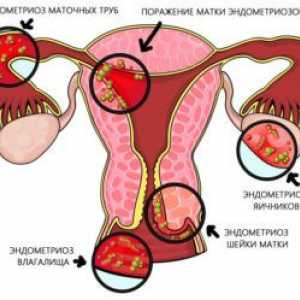 Kako uzeti Janine endometrioze