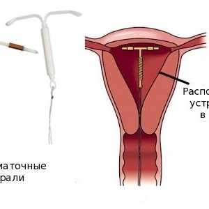 Kako je uklanjanje intrauterini uložak?
