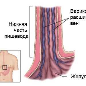 Koji su simptomi jednjaka proširenih vena i kako ga liječiti
