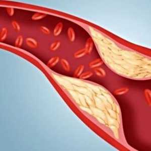 Kako smanjiti razinu kolesterola u krvi