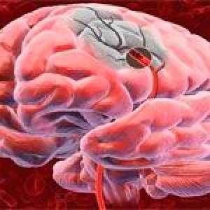 Primarna i sekundarna prevencija moždanog udara