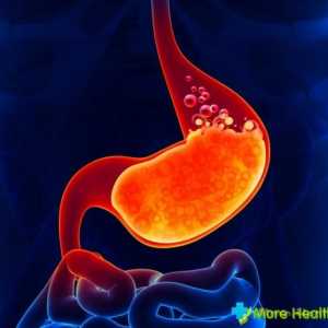 Kako izliječiti heartburn narodnih lijekova? Tradicionalna medicina i prehrana