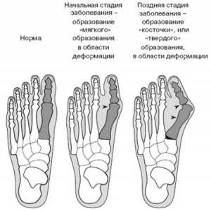 Kako izliječiti kost na nozi: glatka i zdrava stopala