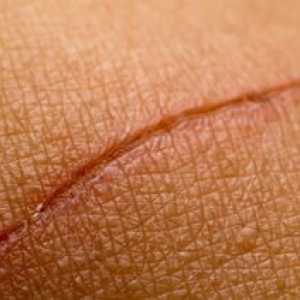 Kako liječiti ožiljke kod kuće?