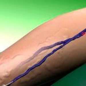 Kako liječiti proširene vene?
