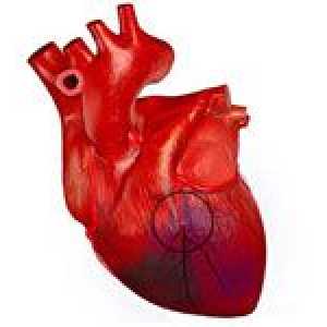 Što bi moglo biti posljedica opsežnog infarkta miokarda?