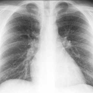 Koji su prvi znakovi bronhitisa u odraslih? Dijagnoza kronične oblike bolesti.