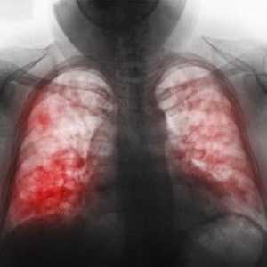 Koji su znakovi upale pluća kod djece? Dijagnoza bolesti.
