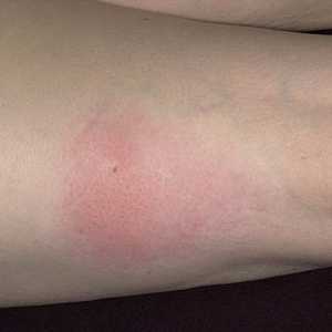 Koji simptomi se javljaju kada alergije na ubode insekata