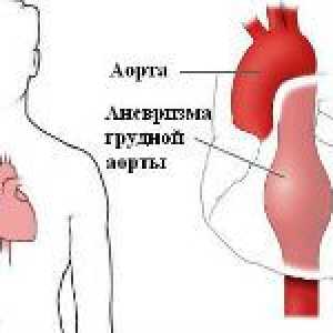 Klinički znakovi aneurizme aorte