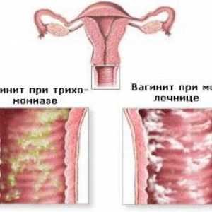 Coleitis (vaginitisa) u muškaraca i žena