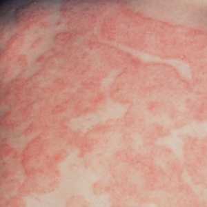 Dermatitisa koža: klasifikacija, dijagnoza i liječenje