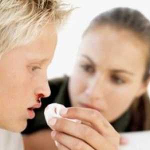 Krvarenje iz nosa - saznati uzrok i naučiti brzo da se zaustavi