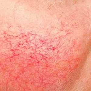 Rosacea kože: uzroci, liječenje