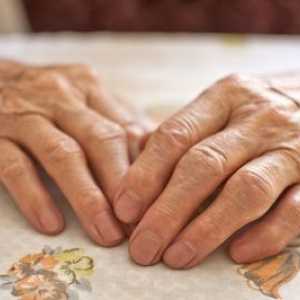 Liječenje artritisa ruku zglobova