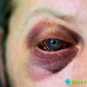 Liječenje hematom oči tek nakon pregleda