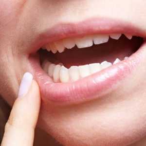 Liječenje herpesa u ustima
