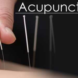 Liječenje kineske akupunkture
