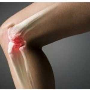 Liječenje zglob koljena nakon ozljede narodnih lijekova