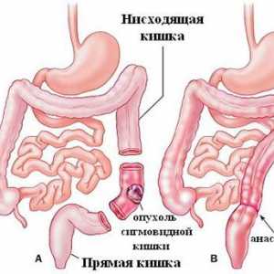 Liječenje polipa u debelom crijevu sigmoidalne