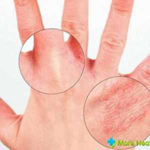 Liječenje seboroičnog dermatitisa: uzroci