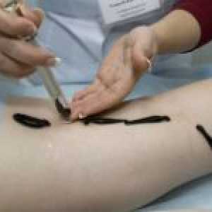 Liječenje varikoze pijavice (girudoterapija)