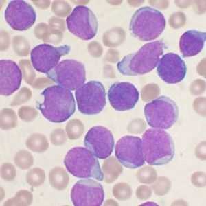 Leukemije (leukemija): vrste, simptomi, prognoza, liječenje, uzroci