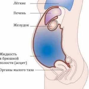 Postupci dijagnostici i liječenju abdominalnih ascitesa