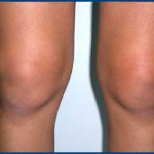 Metode liječenja sinovitis koljena. Simptomi ove bolesti.