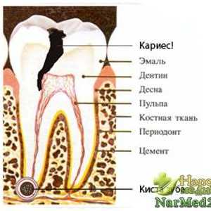 Metode tradicionalne medicine u liječenju cista zuba