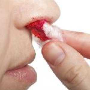 Glavni uzroci krvarenja iz nosa
