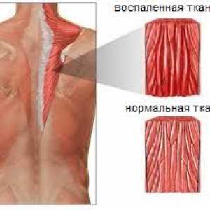 Miozitis mišići leđa i vrata