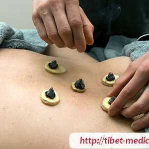 Moksoterapiya - zagrijavanje akupunkturnih točaka