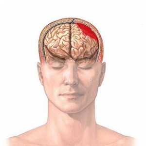 Cerebralna hematom: vrste, uzroci, simptomi, liječenje, posljedice